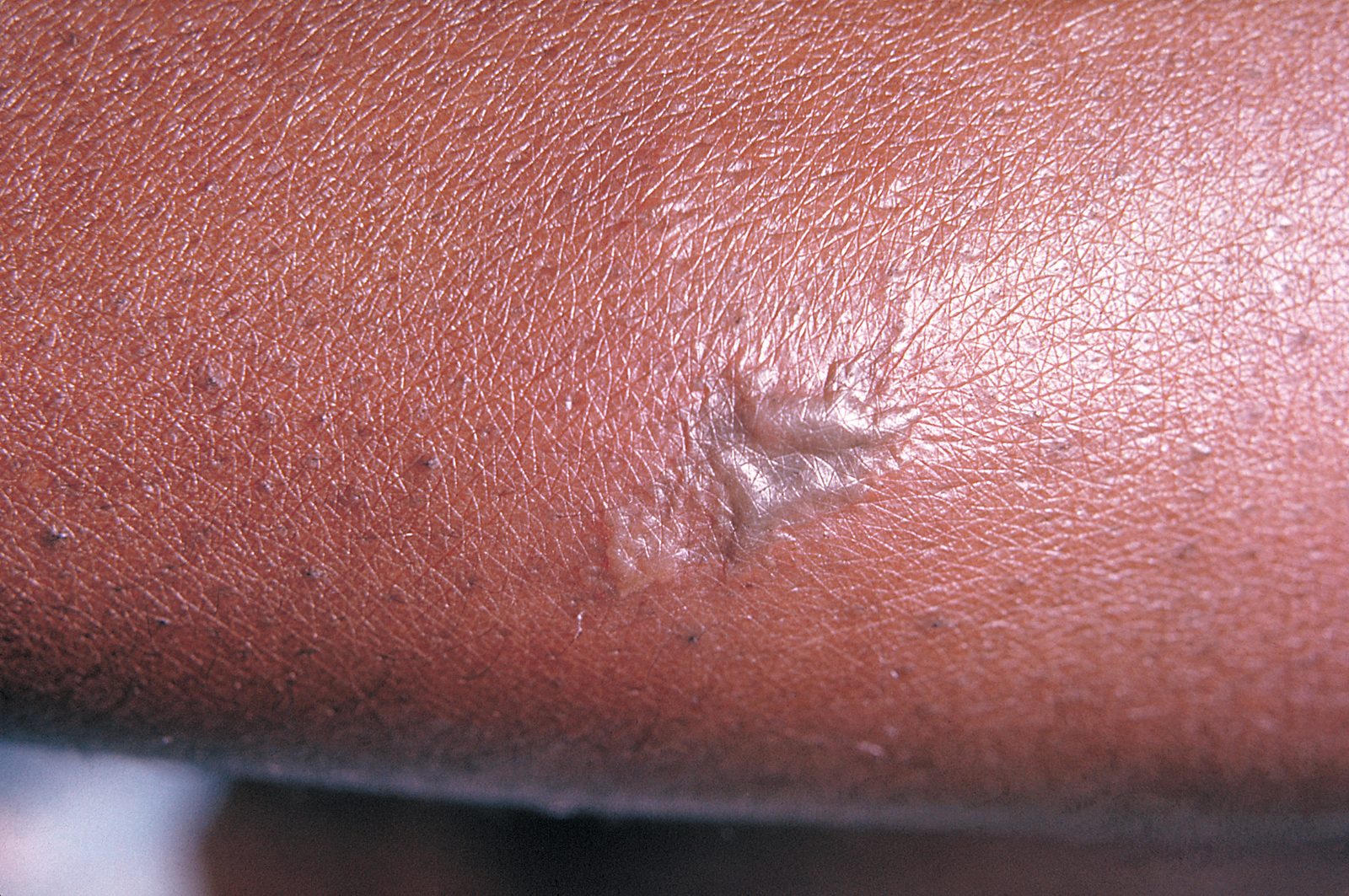 Clinical photograph of the pustular skin lesions associated with bacteraemic spread and septic arthritis.