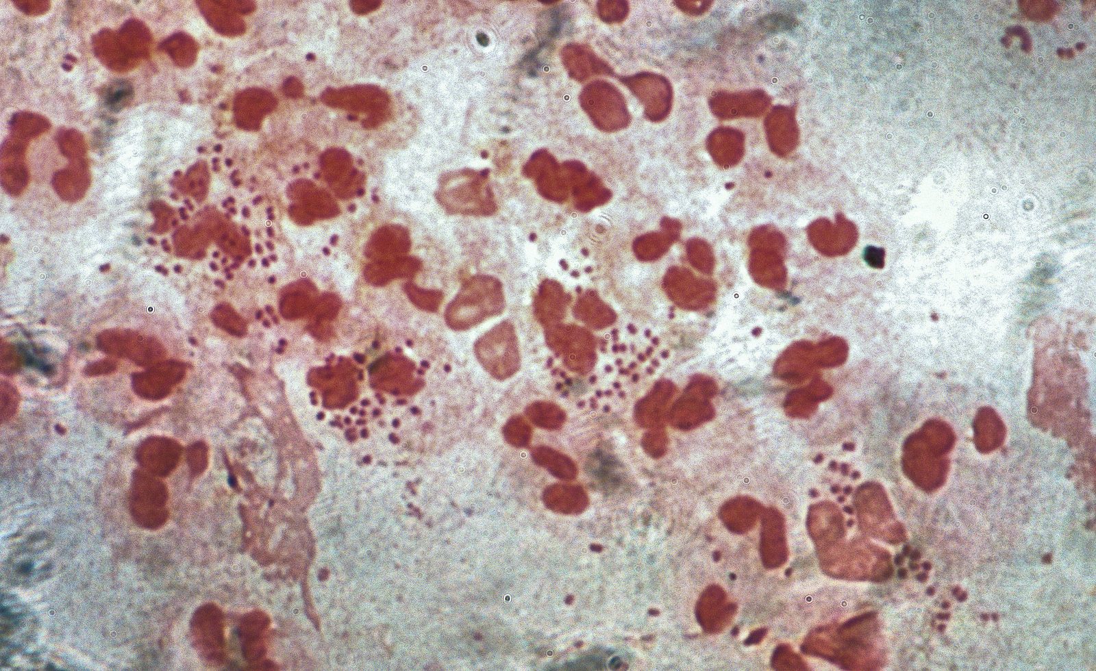 Microscopy image of Gram-negative intracellular diplococci within neutrophils from a urethral or endocervical smear.