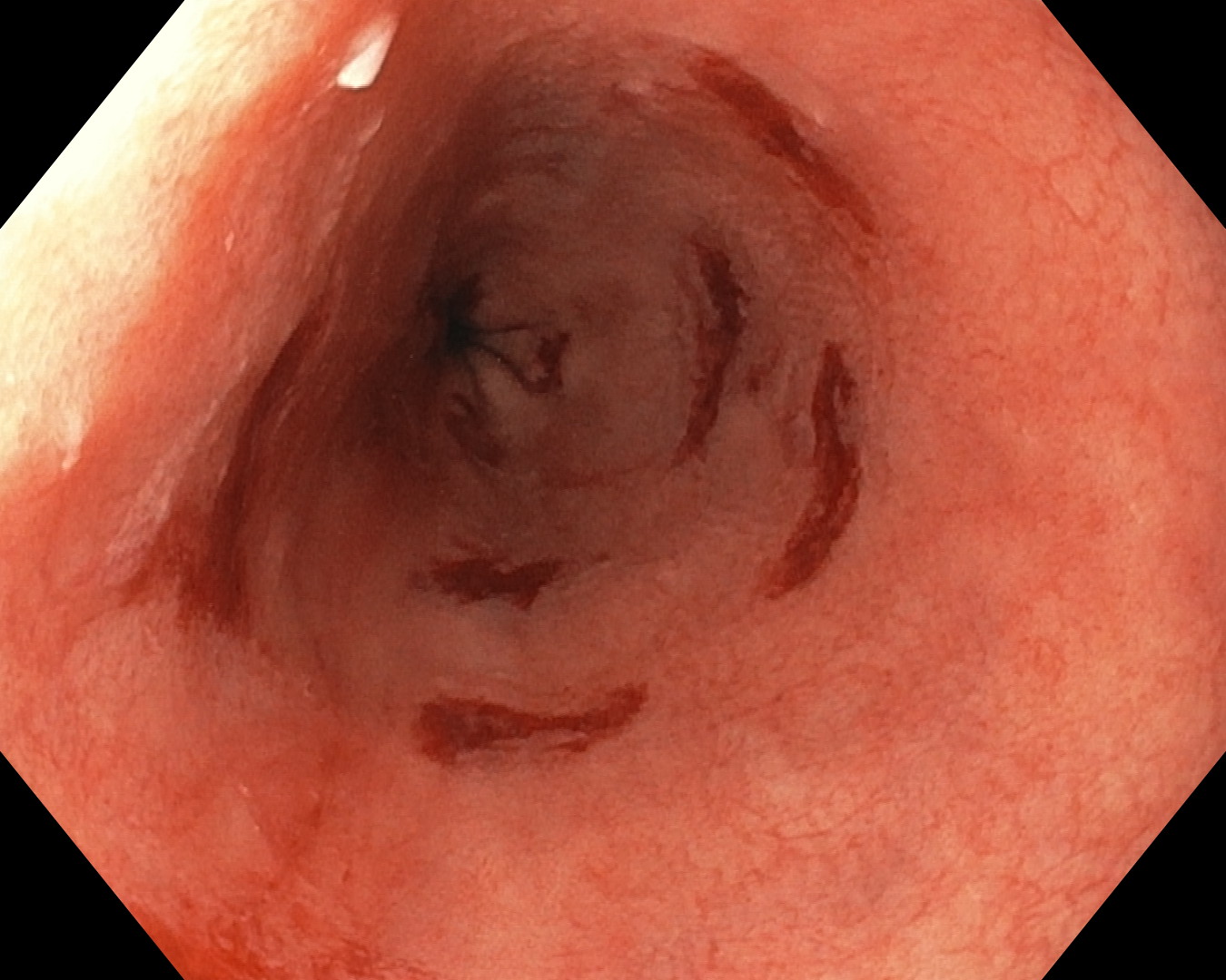 Endoscopic and histological representation of columnar metaplasia replacing distal oesophageal squamous mucosa; interpretation requires endoscopy and histopathology.