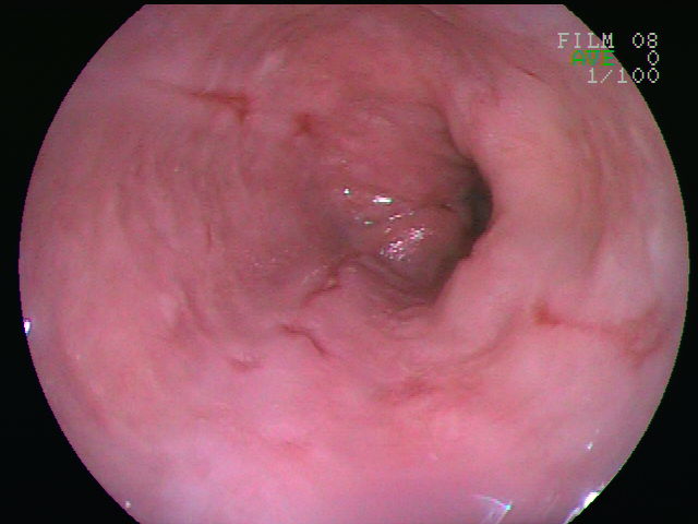 Endoscopic view of severe reflux oesophagitis with circumferential mucosal inflammation, ulceration and narrowing of the distal oesophageal lumen.