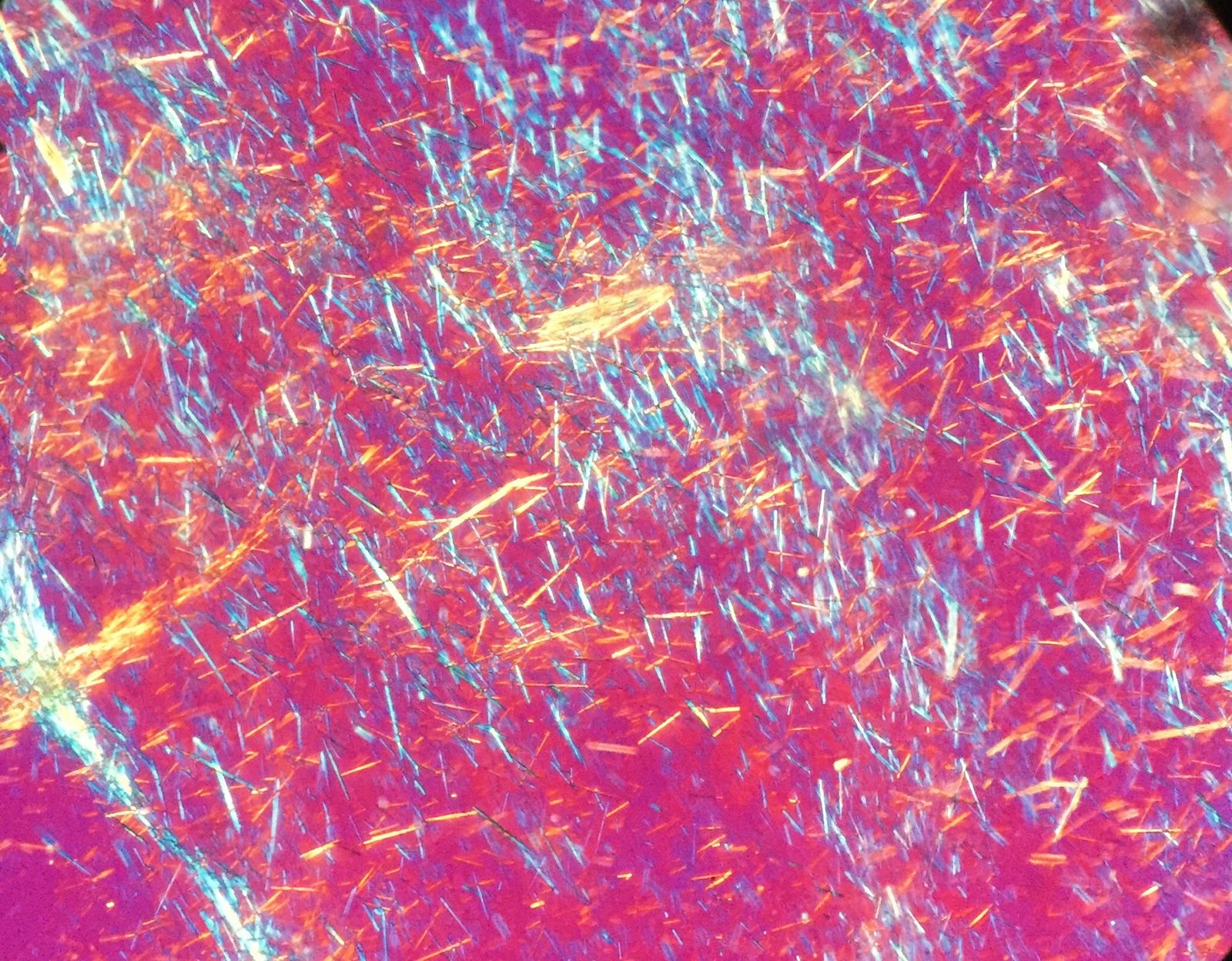 Polarised-light microscopy of synovial fluid showing needle-shaped monosodium urate crystals; urate crystals are negatively birefringent.