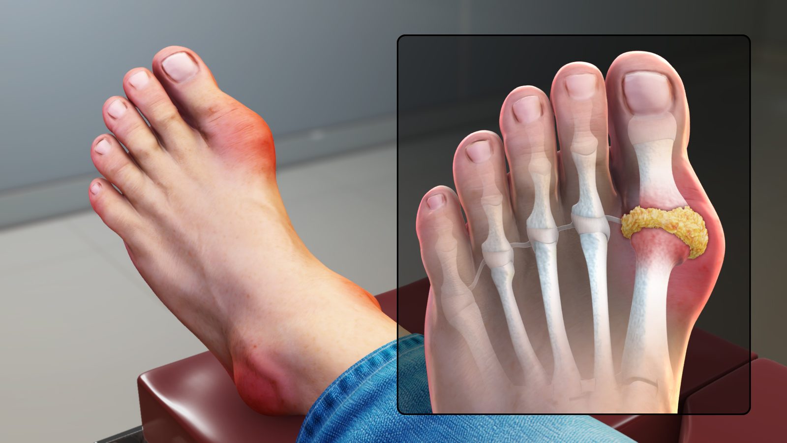 An illustration of acute gout (podagra), showing a red, swollen first metatarsophalangeal joint and monosodium urate crystal deposition.
