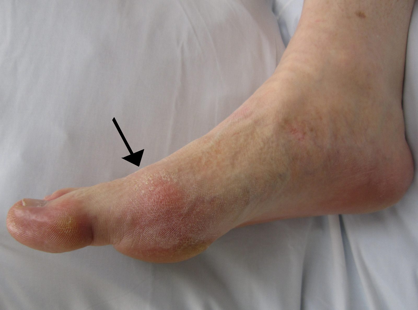 Clinical photograph of an acutely red, swollen first metatarsophalangeal joint typical of a first gout attack.