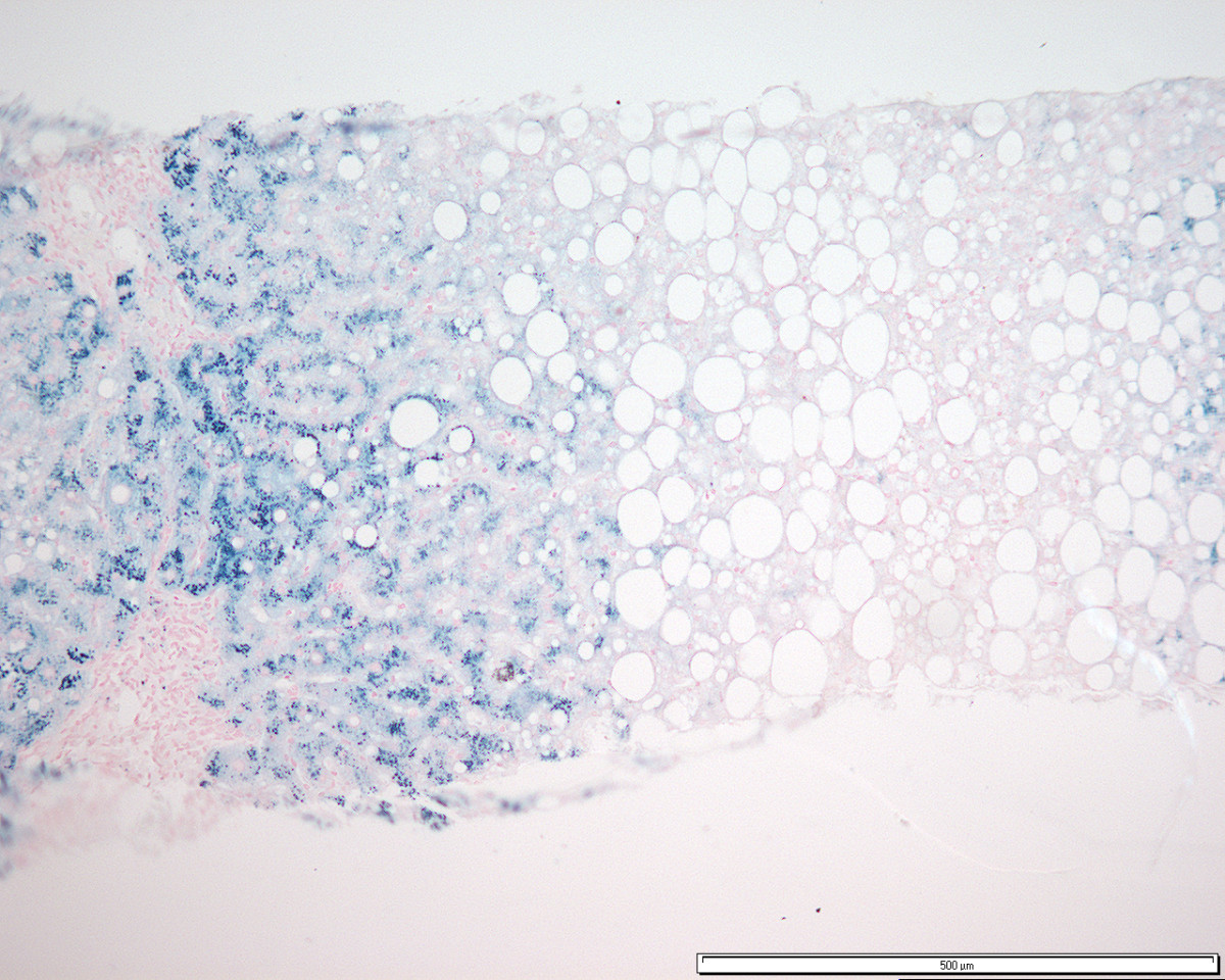 A liver histology section stained with Perls Prussian blue, showing heavy blue granular iron deposition within hepatocytes.