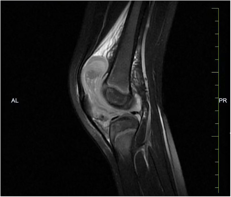 Sagittal T2-weighted MRI showing a large suprapatellar and joint effusion with synovial hypertrophy and soft-tissue swelling in haemophilic knee bleeding.
