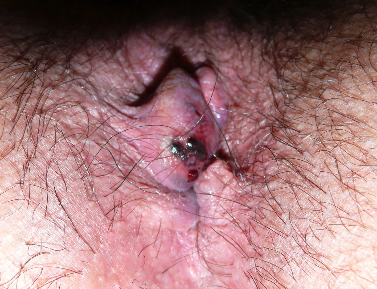Clinical photograph of a tender, bluish perianal swelling representing an acutely thrombosed external haemorrhoid.