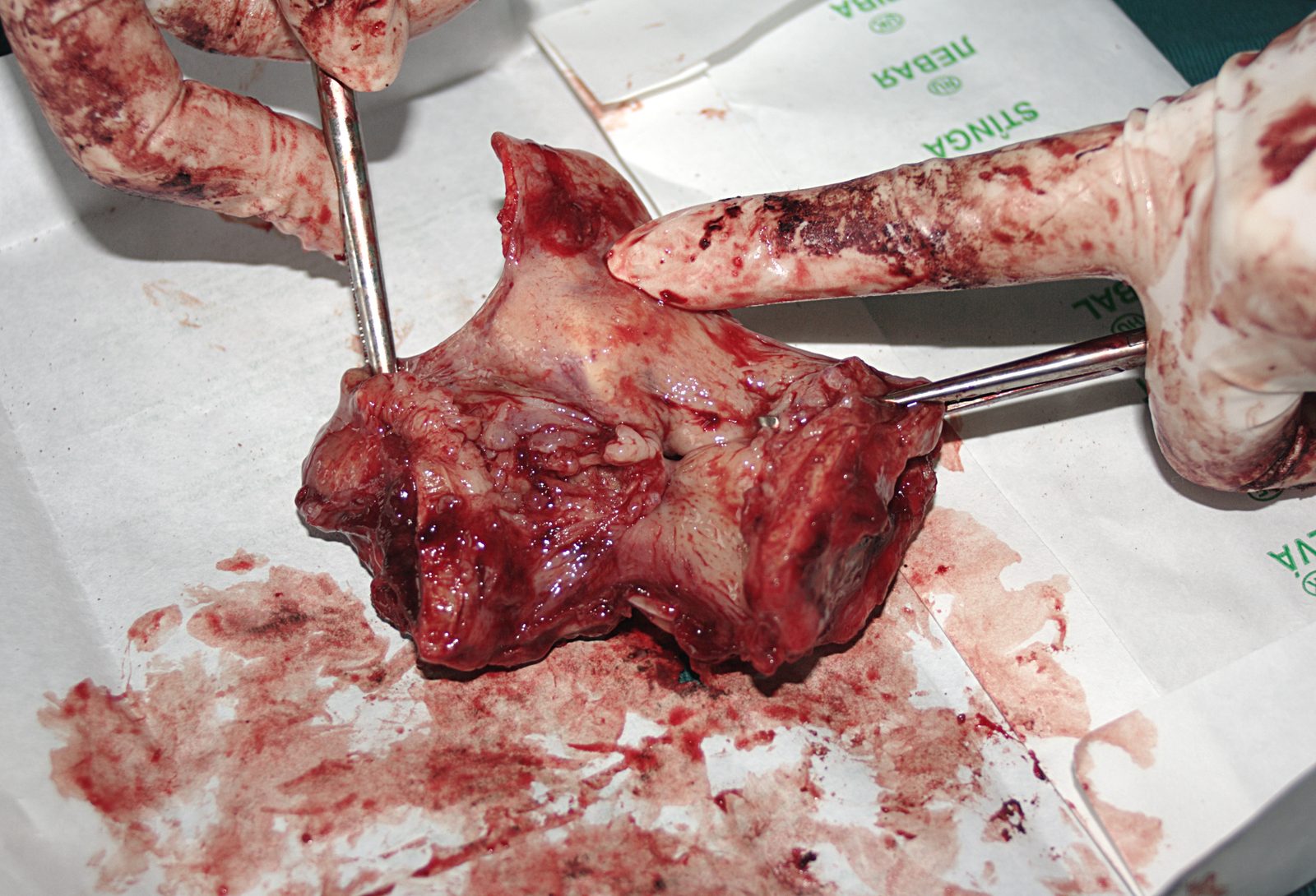 A gross surgical specimen of a dissected larynx showing a large ulcerated and infiltrative laryngeal tumour.