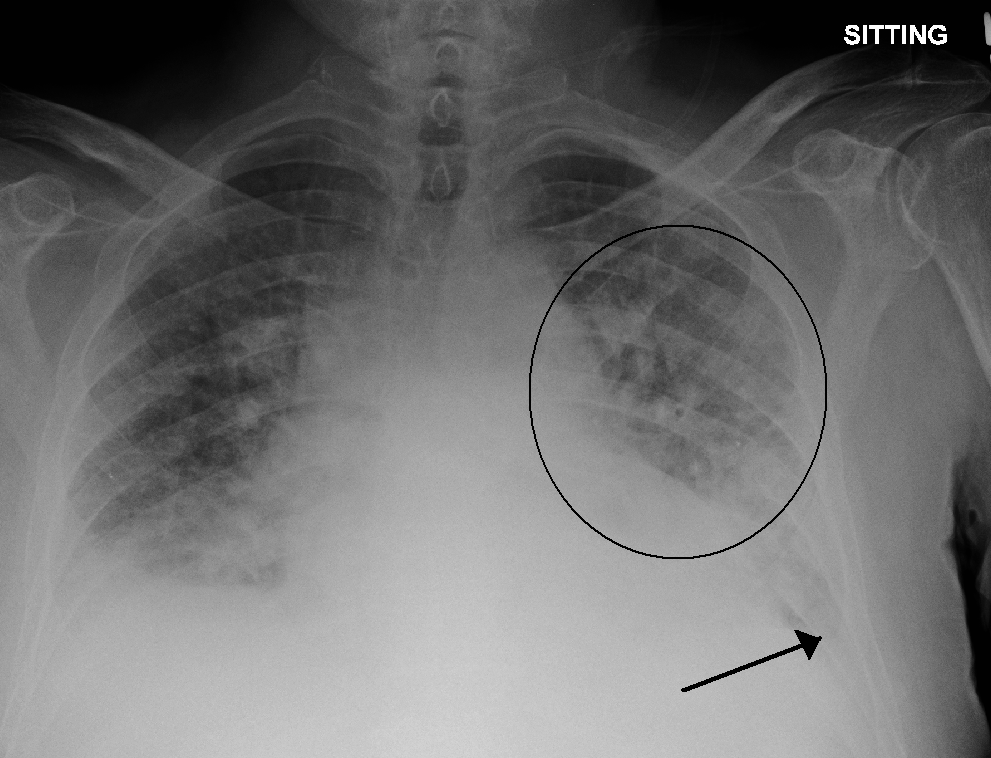 Sitting anteroposterior chest radiograph showing cardiomegaly, bilateral perihilar and basal pulmonary oedema and small pleural effusions in decompensated heart failure.
