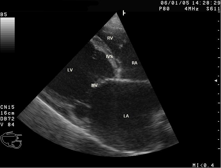 Echocardiographic still illustrating a dilated left ventricle with reduced systolic function; ejection fraction is one component of the full heart-failure assessment.