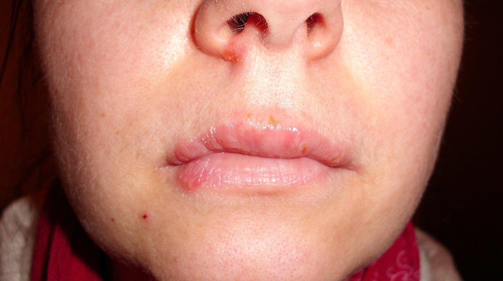 A clinical photograph showing multiple herpes labialis lesions around the upper lip and nostril, including small vesicular and crusted areas.