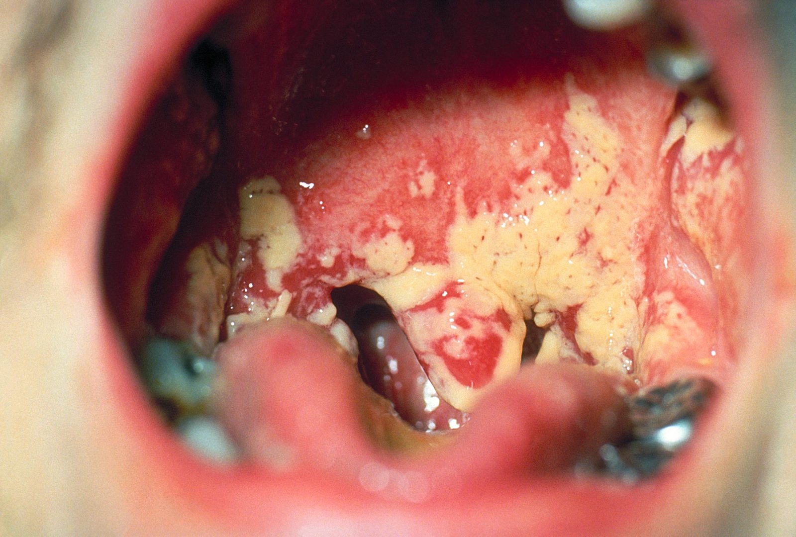 Clinical photograph of white plaques of oral candidiasis on the tongue and buccal mucosa, an indicator of immune compromise but not specific for HIV.