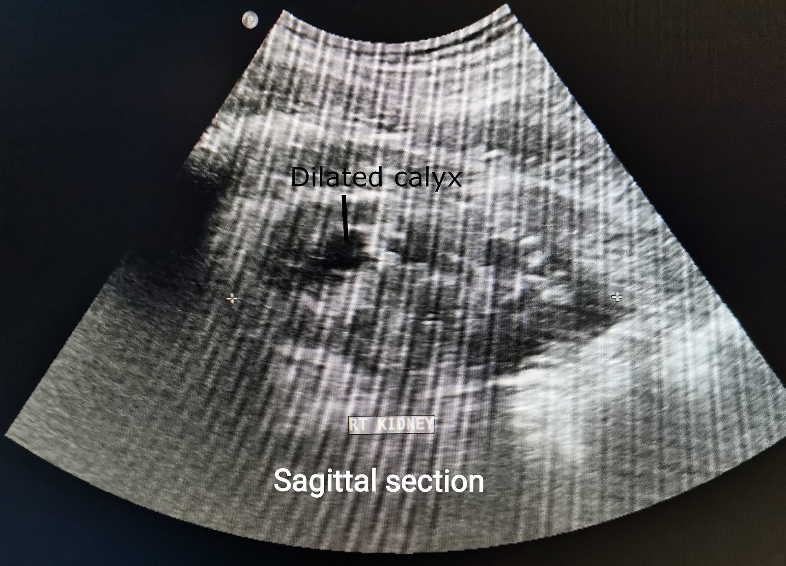 A renal ultrasound image showing a dilated, anechoic pelvicalyceal system (ballooned renal pelvis and blunted calyces) within the kidney.