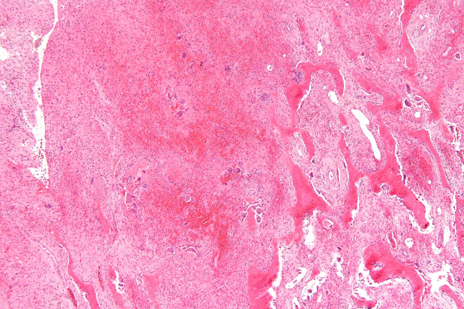 H&E section of a brown tumour showing haemorrhage, fibroblastic stroma and multinucleated giant cells, a skeletal consequence of prolonged PTH-driven bone resorption that may accompany hypercalcaemia.