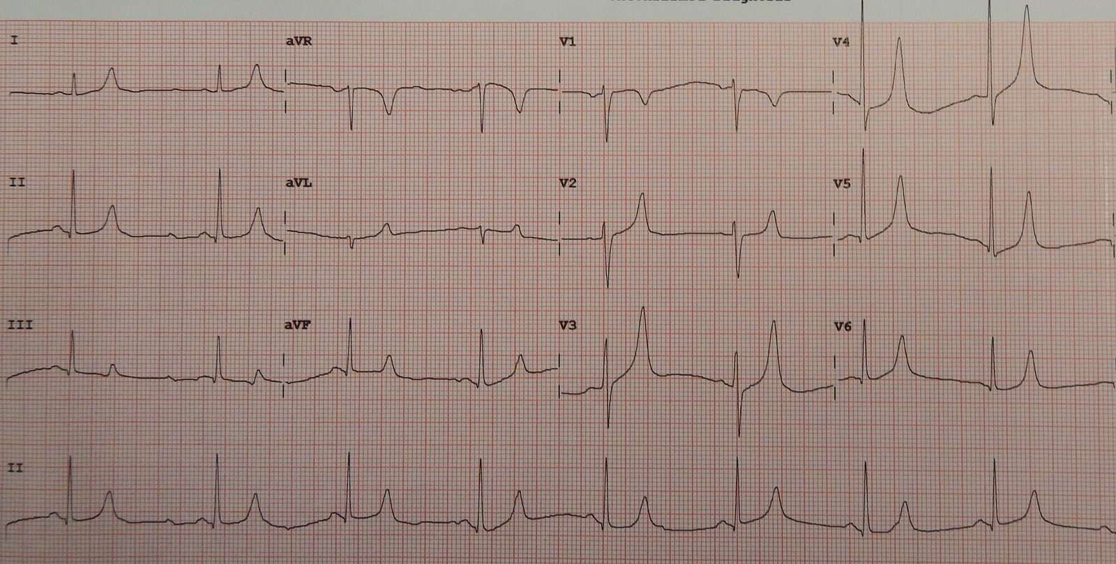Twelve-lead ECG from a patient with a serum potassium of 5.7 mmol/L showing tall, peaked T waves, the earliest electrical change of hyperkalaemia.