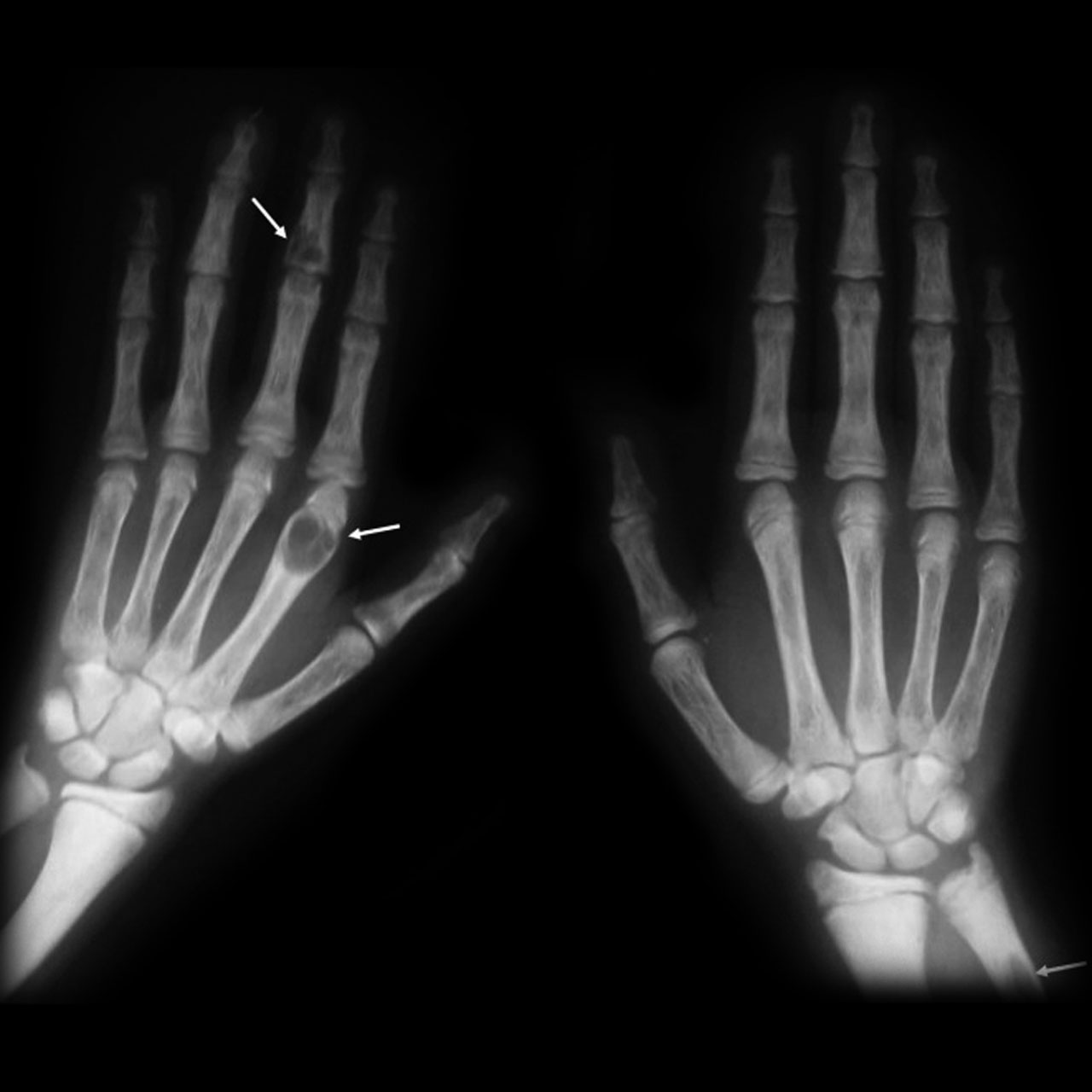 Bilateral hand radiographs showing expansile lucent brown tumours associated with severe long-standing hyperparathyroid bone disease.