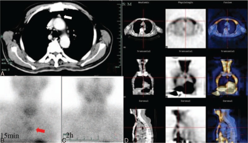 A technetium-99m sestamibi parathyroid scan showing focal retained tracer corresponding to a hyperfunctioning parathyroid adenoma; localisation is for operative planning rather than diagnosis.