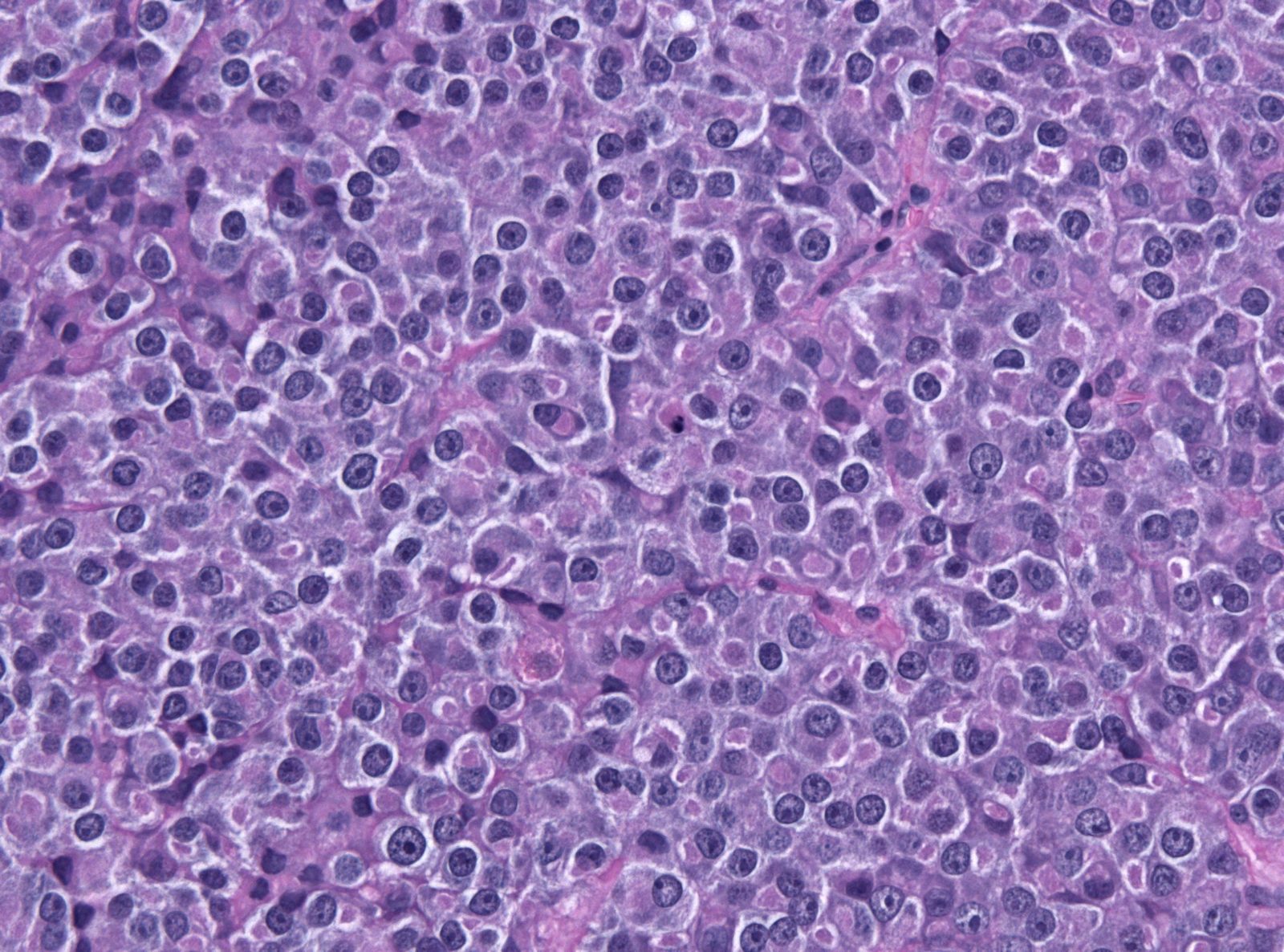 H&E histology of a prolactin-producing pituitary adenoma, a common pathological cause of persistent hyperprolactinaemia.