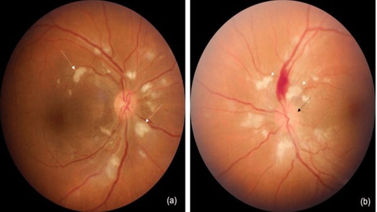 Fundus photographs showing cotton-wool spots, a flame-shaped haemorrhage and optic-disc swelling. Retinal haemorrhage or papilloedema with severe hypertension requires same-day specialist assessment.