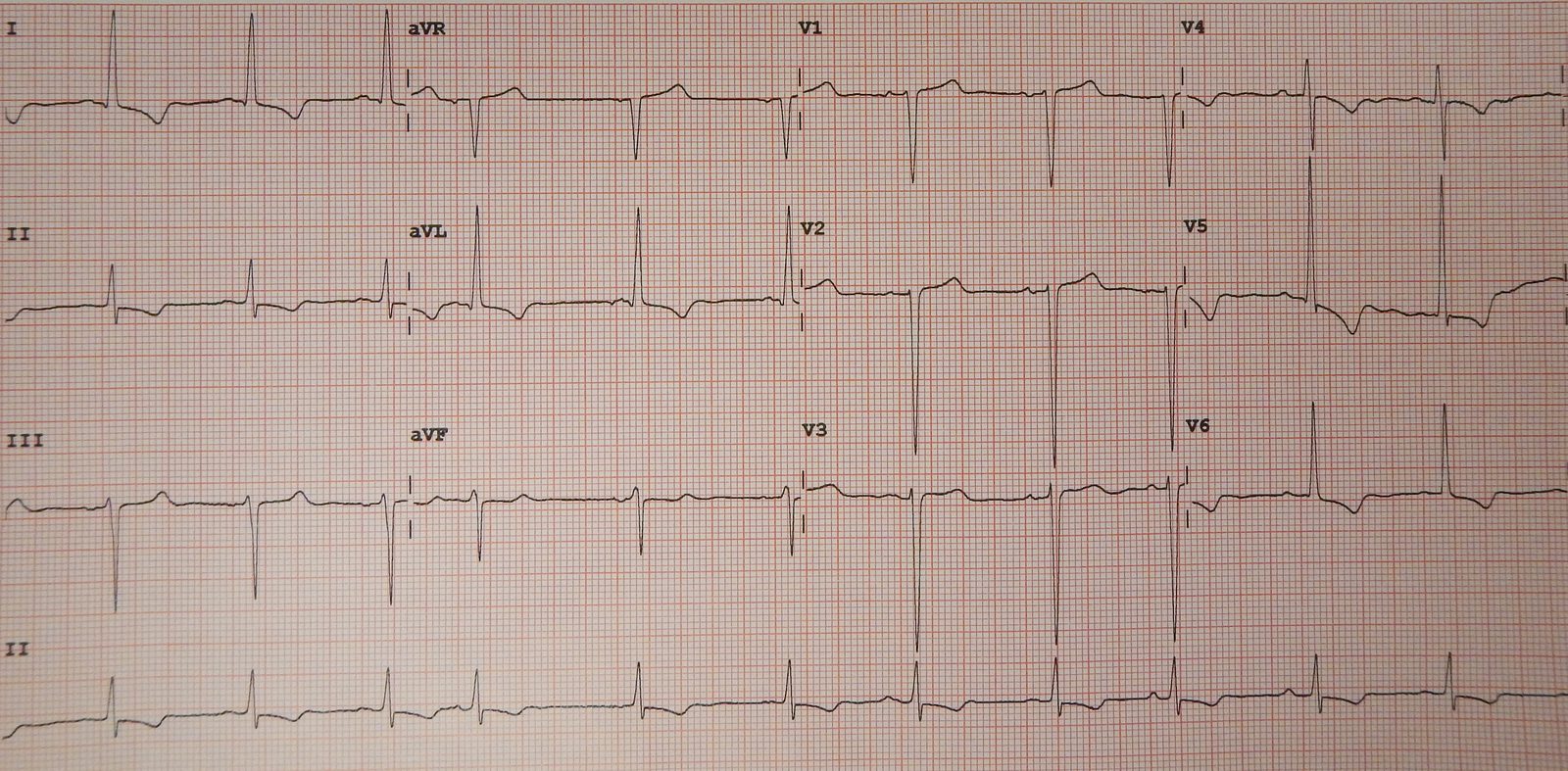 Twelve-lead ECG showing voltage and repolarisation features of left-ventricular hypertrophy from chronic pressure load.