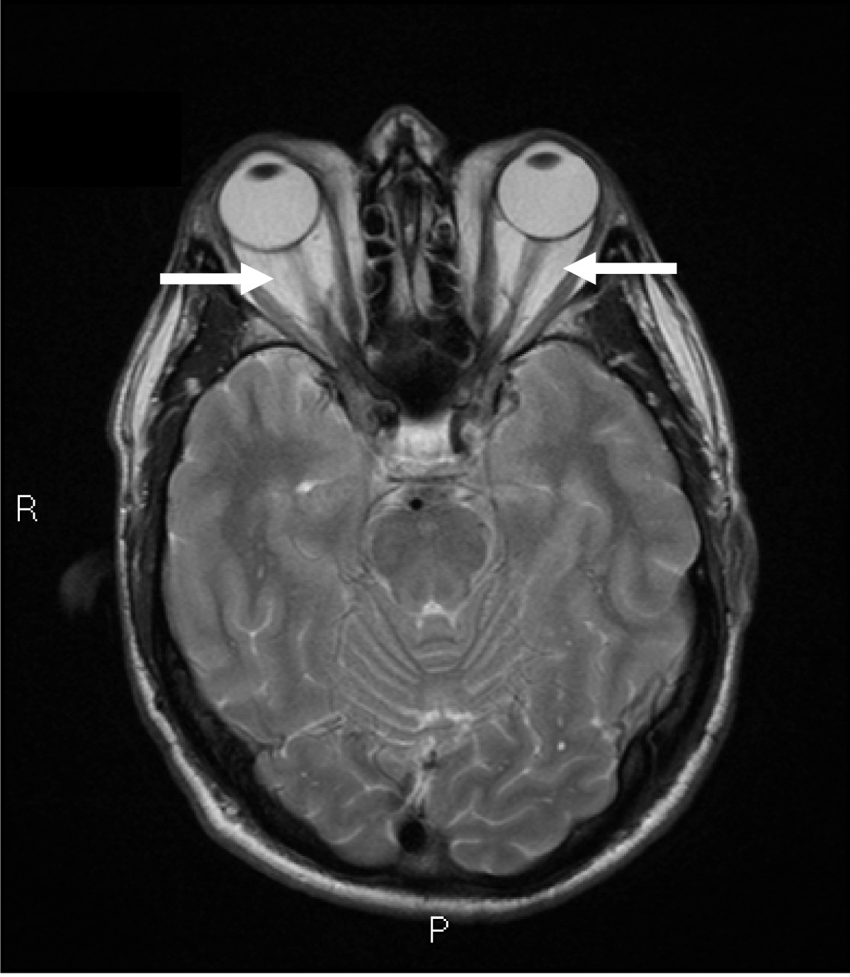 Clinical photograph showing exophthalmos, lid retraction and periorbital swelling characteristic of Graves' thyroid eye disease.