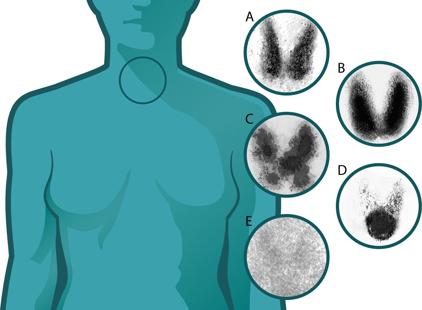 Composite image comparing diffuse uptake in Graves' disease, focal uptake in a toxic adenoma and patchy uptake in multinodular goitre.