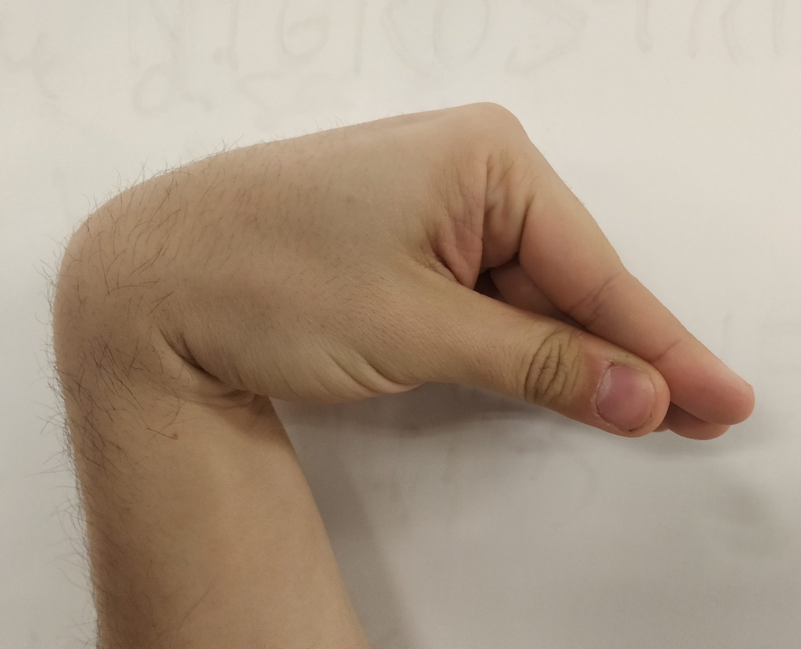 A recreated positive Trousseau posture showing carpopedal spasm with wrist and metacarpophalangeal flexion and extension of the fingers in latent hypocalcaemic tetany.
