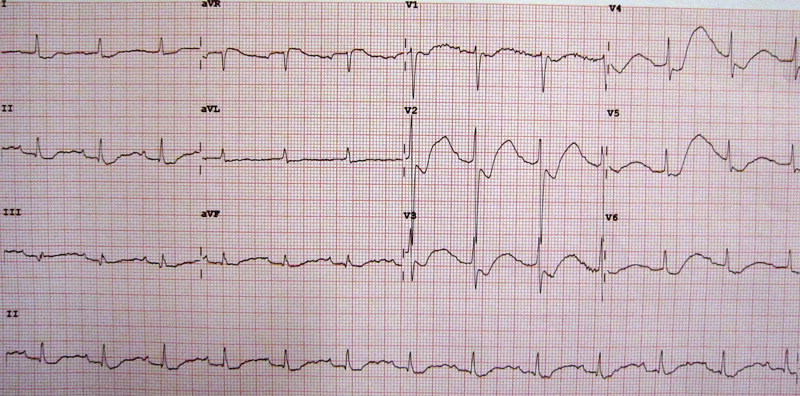 An ECG strip showing flattened T waves, ST depression and prominent U waves after the T wave, the characteristic pattern of hypokalaemia.