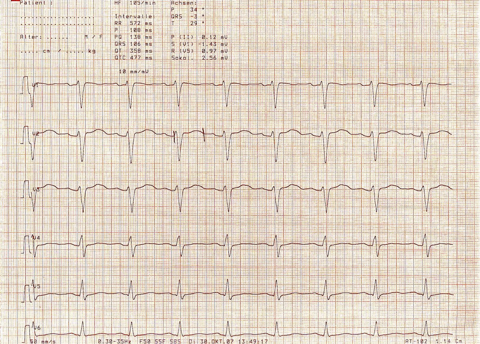 An ECG example with a prolonged QT interval, illustrating the cardiac effect that increases urgency in symptomatic hypocalcaemia.