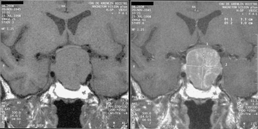 A sagittal or coronal MRI of the pituitary showing a sellar or suprasellar mass that may compress the gland or optic chiasm.