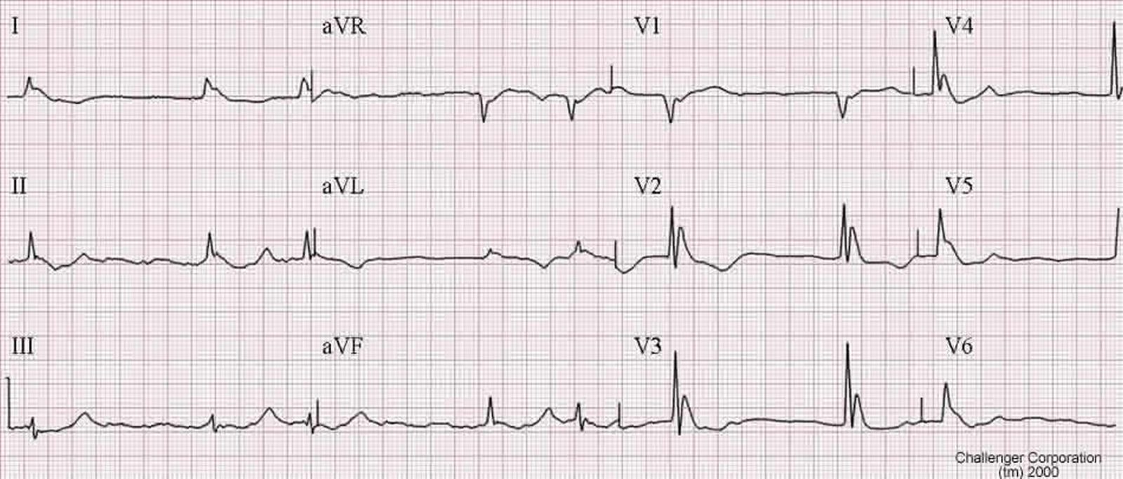 Twelve-lead ECG in hypothermia. After each QRS complex there is an extra positive deflection at the J point, the J (Osborn) wave. It is visible here across the precordial leads V2 to V6 and in the inferior leads. Its height grows as the core temperature falls. Hypothermia also slows conduction, prolonging the PR, QRS and QT intervals.