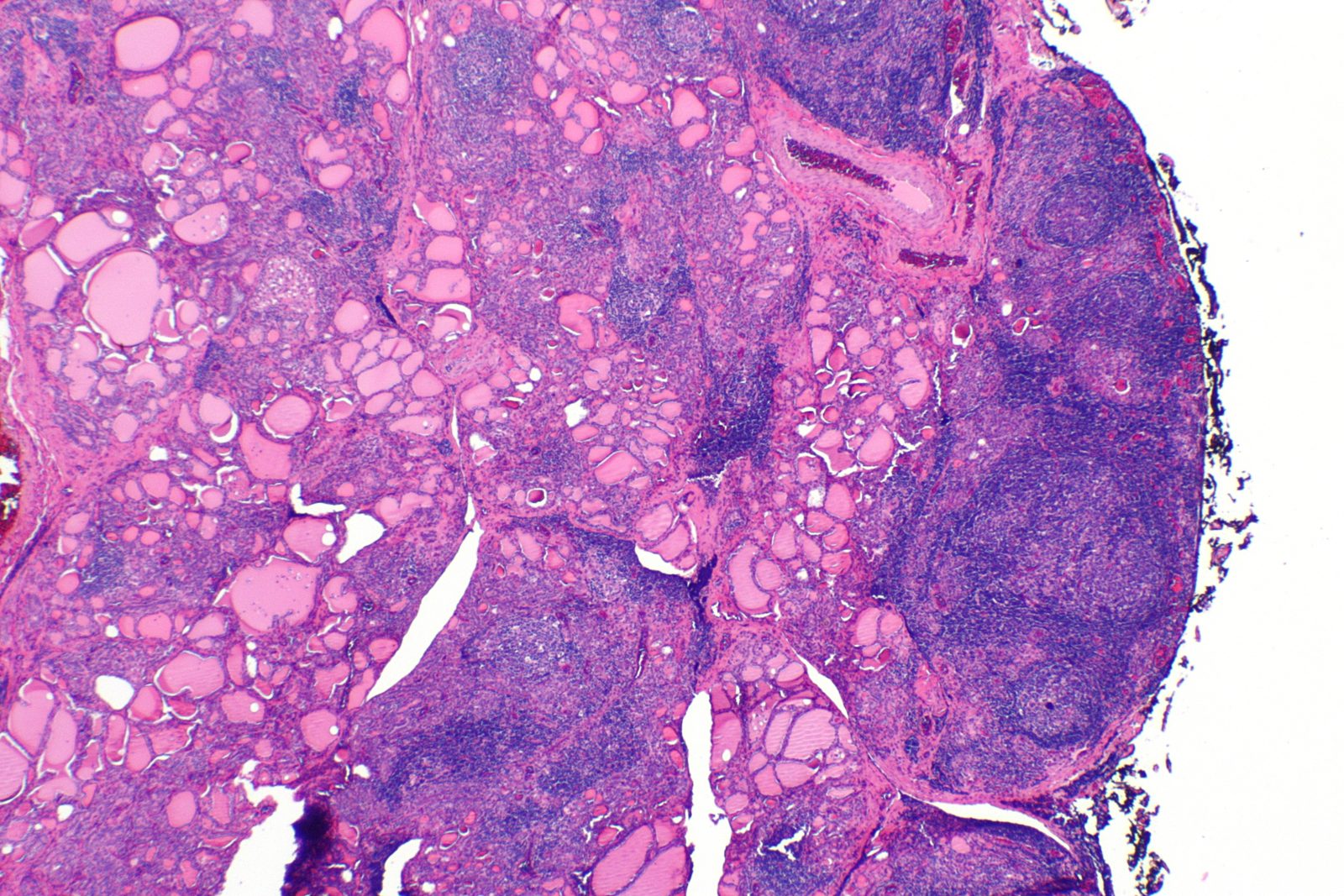 Photomicrograph showing lymphocytic infiltration and germinal centre formation typical of autoimmune thyroiditis.