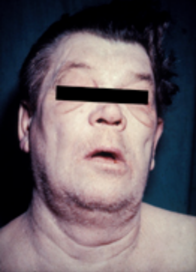 Clinical photograph illustrating periorbital puffiness, dry skin and hair thinning characteristic of significant hypothyroidism.