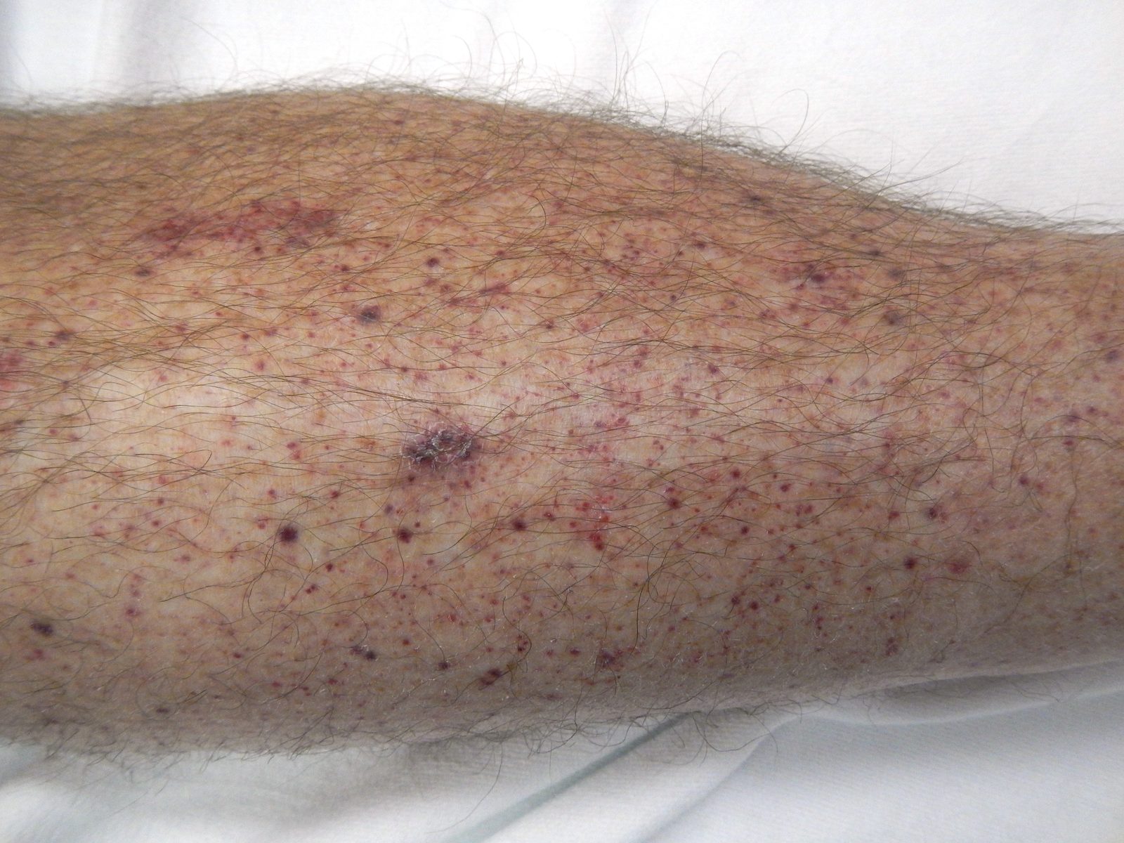 A clinical photograph showing widespread petechiae and small purpuric lesions across the lower leg in severe immune thrombocytopenia.