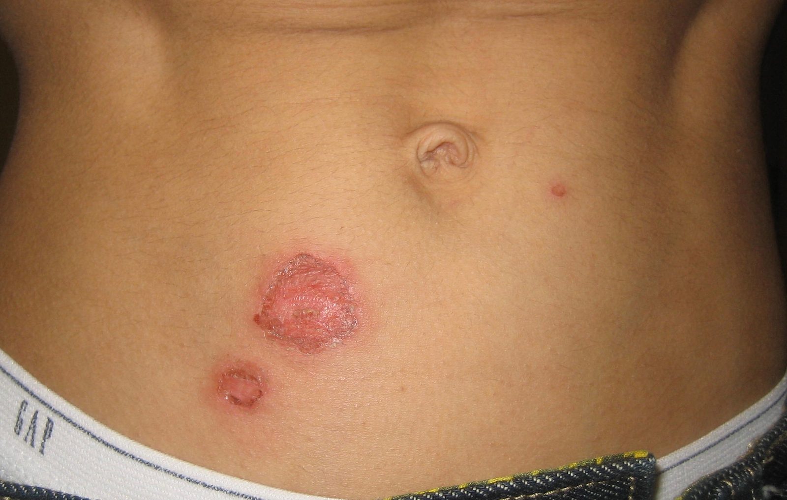 Clinical photograph of flaccid blisters and a scale collarette in bullous impetigo, illustrating the distinction from non-bullous crusted disease.