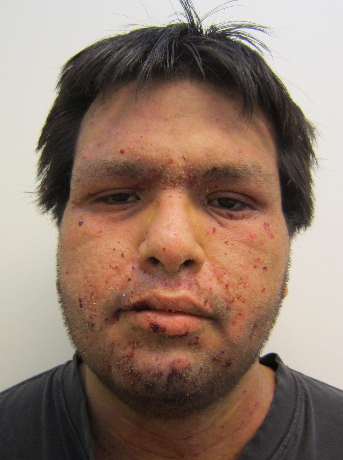 Clinical photograph showing facial superficial erosions and yellow-brown crusted lesions in non-bullous impetigo; include a range of skin tones in the wider image campaign.