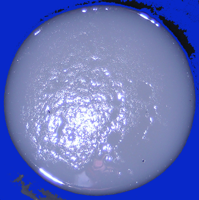 Clinical teaching image contrasting profuse watery diarrhoea with bloody or mucoid dysentery; the image should not be used alone to identify a pathogen.