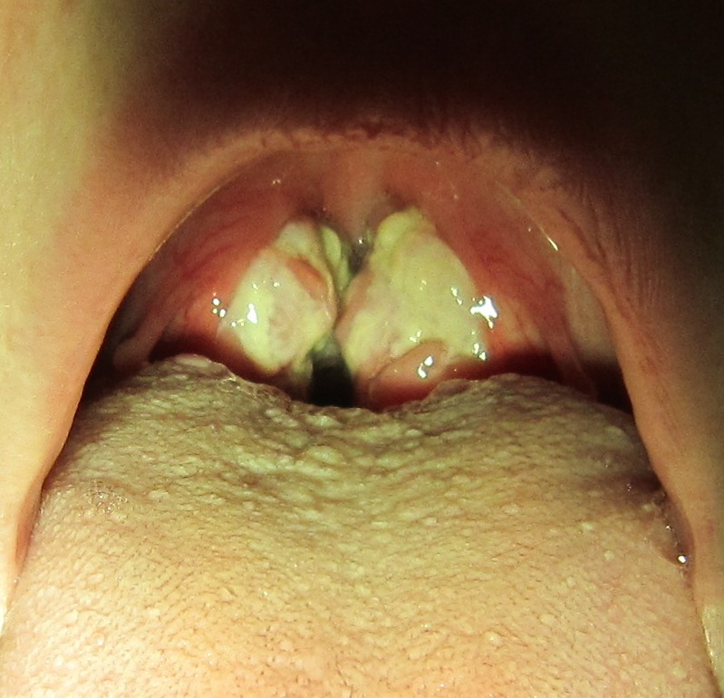 A clinical photograph of markedly enlarged tonsils with exudate, resembling bacterial tonsillitis, in infectious mononucleosis.