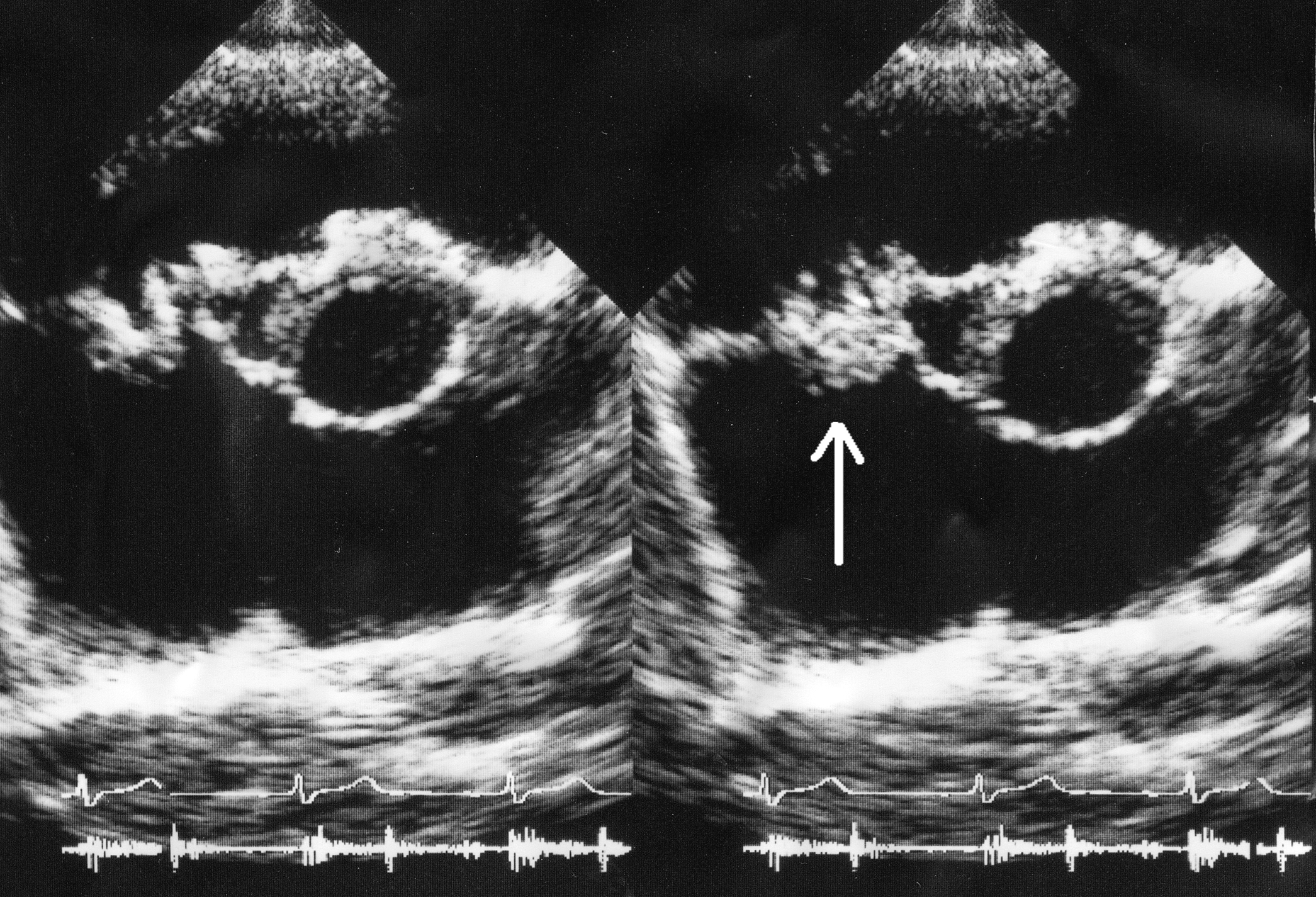 Echocardiographic still demonstrating a vegetation attached to a heart valve leaflet with associated regurgitation.