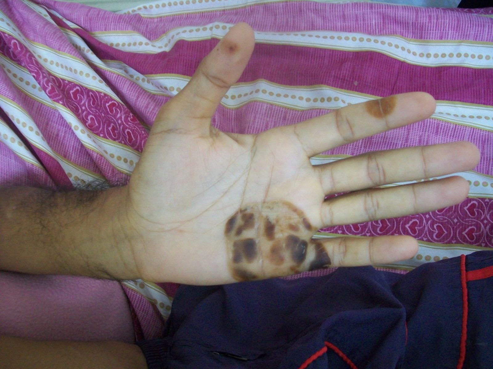 Composite clinical image of splinter haemorrhages, Janeway lesions, Osler's nodes and Roth spots produced by septic emboli and immune-complex deposition.
