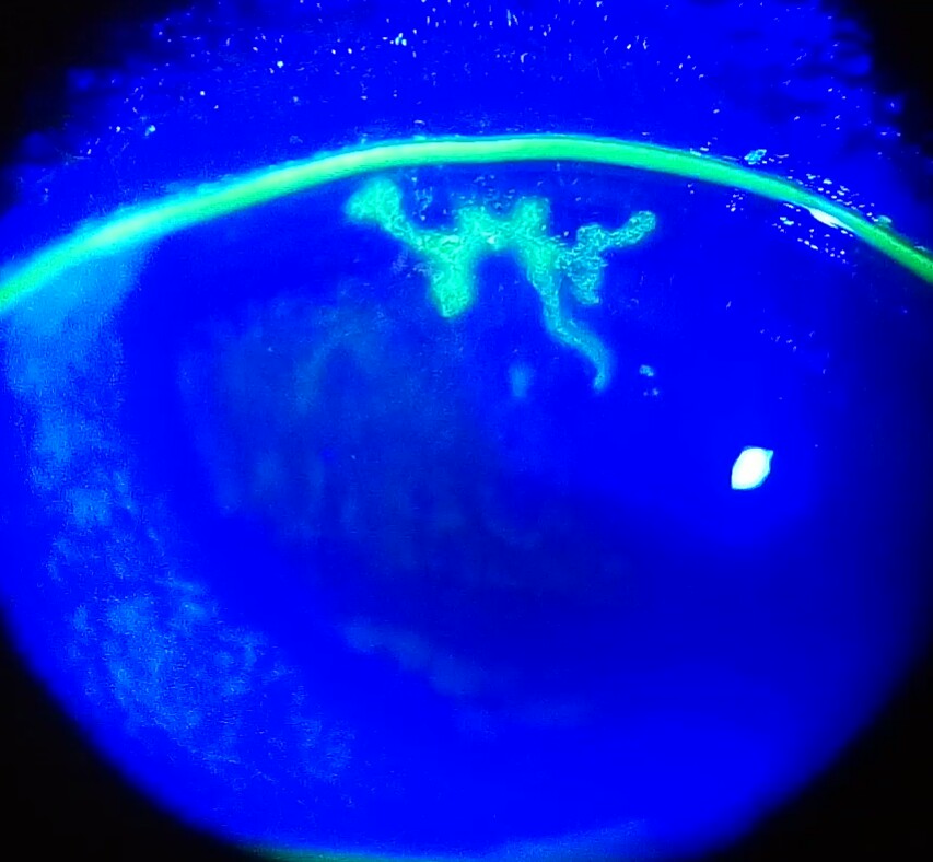 Fluorescein-stained branching dendritic epithelial ulcer of HSV keratitis under blue light; include the warning that steroid monotherapy can worsen active infection.