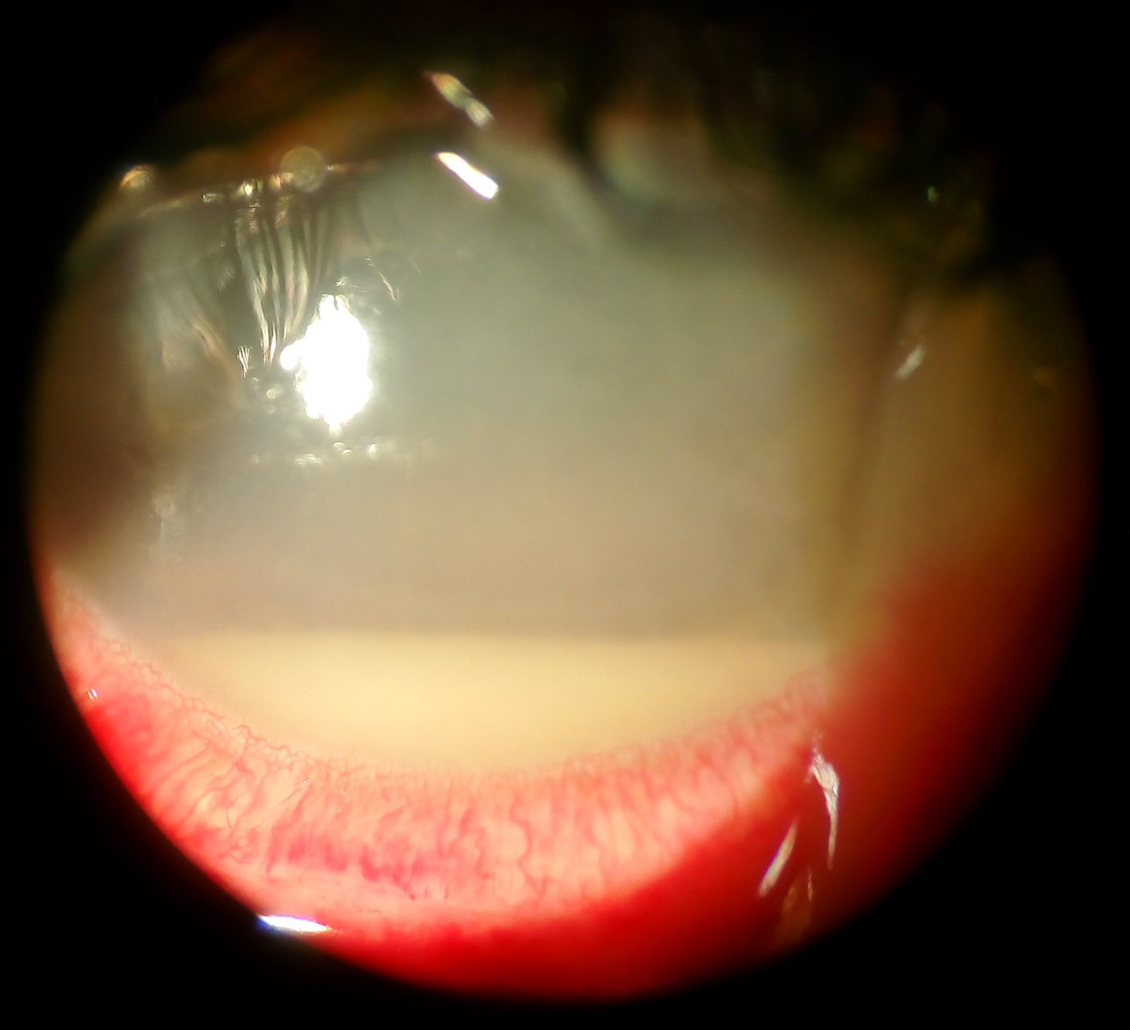 Slit-lamp photograph showing corneal opacity with a layered hypopyon, illustrating severe anterior-chamber inflammation. Label it as an emergency clinical example rather than a diagnostic substitute.