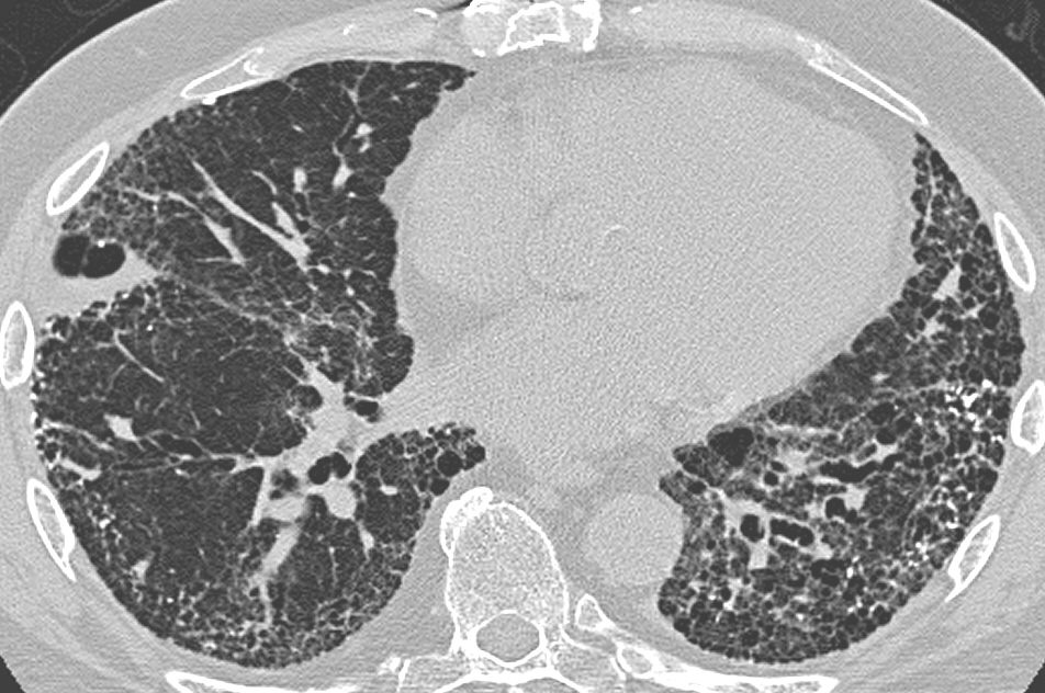 CT chest image showing peripheral, bibasal reticular shadowing and honeycomb change in a usual interstitial pneumonia pattern.
