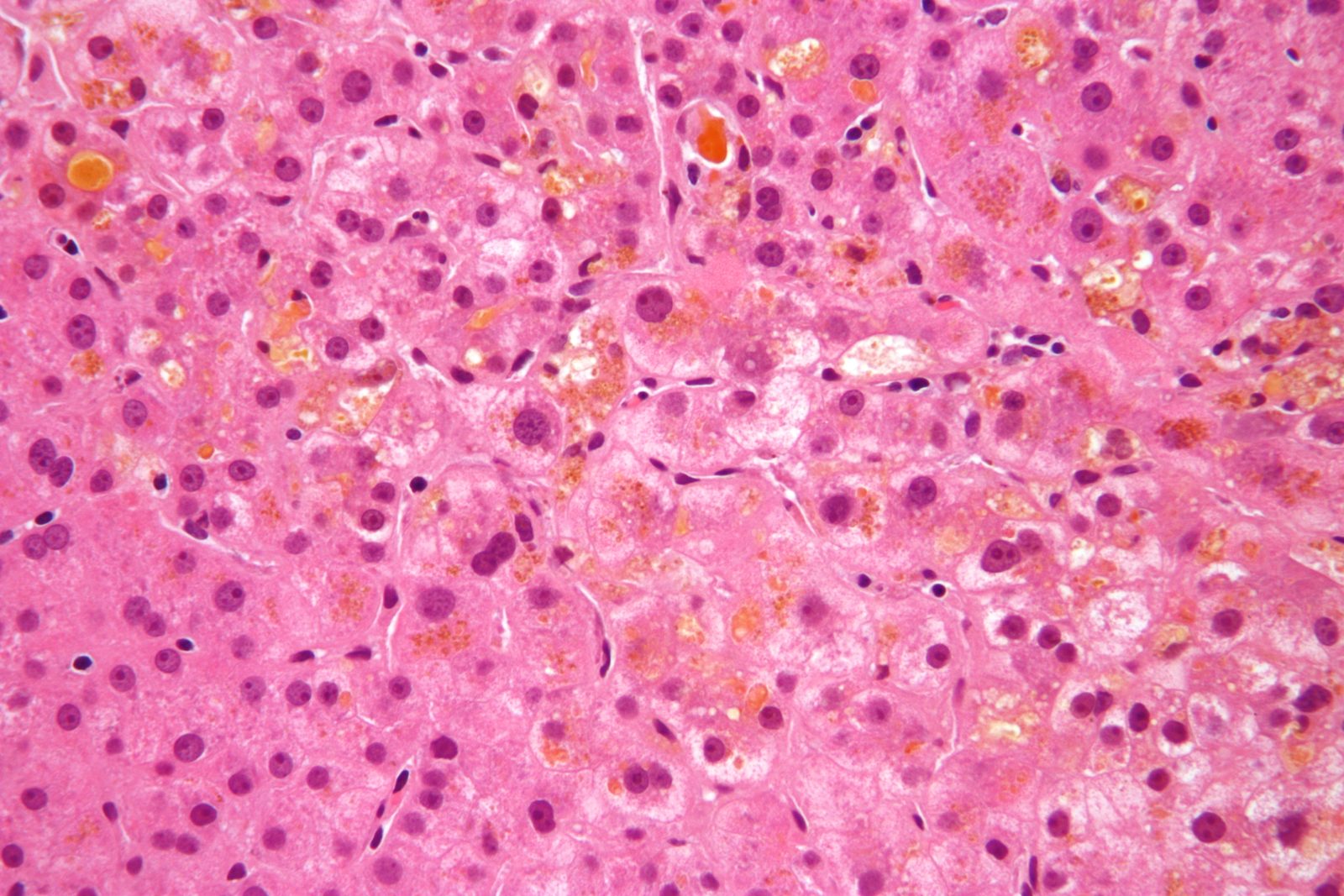 H&E liver histology showing canalicular bile plugs and cholestatic pigment within hepatocytes, illustrating the cholestatic process; the clinical hallmark is itch without a primary rash.