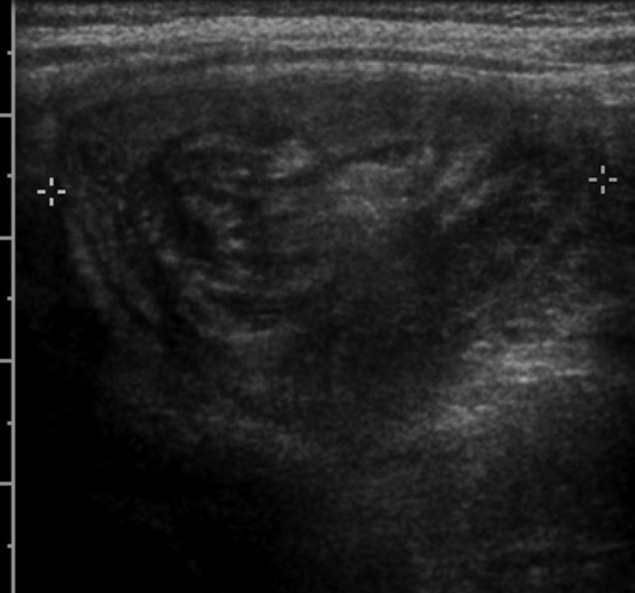 Transverse ultrasound showing concentric alternating bowel-wall rings producing the target or doughnut sign.