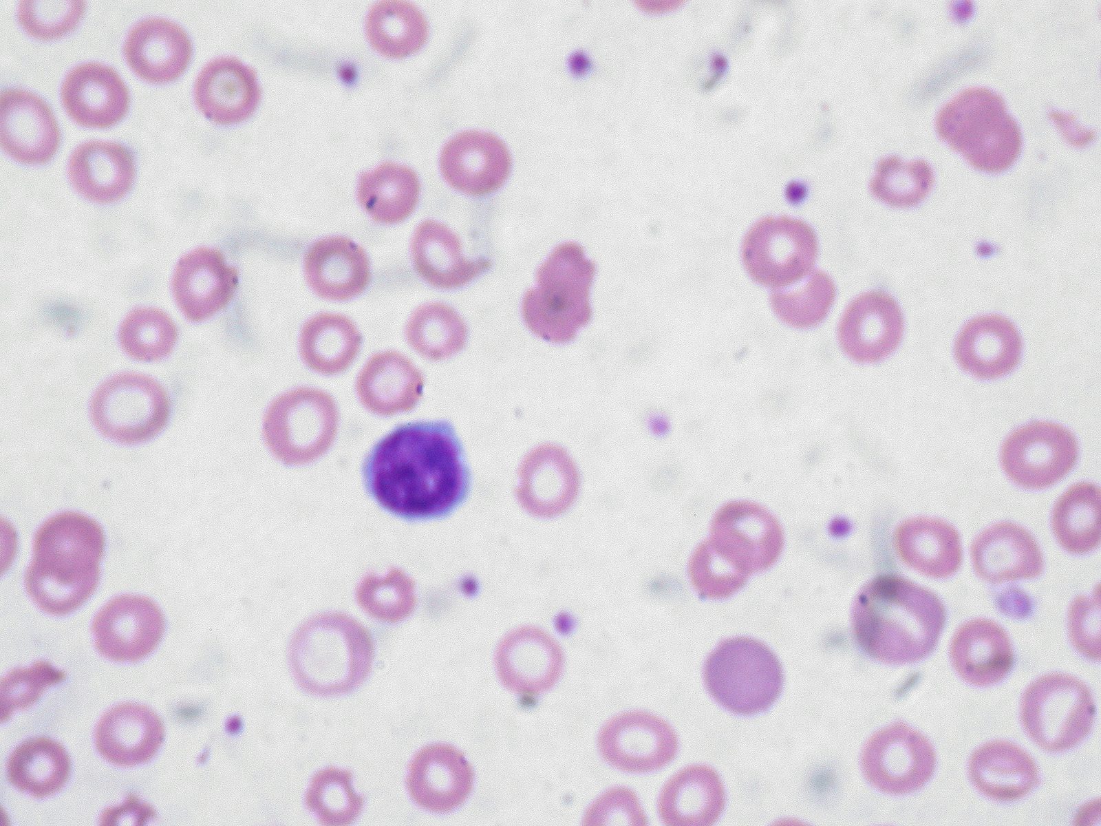 Peripheral blood film showing microcytic, hypochromic red cells with anisopoikilocytosis and pencil cells; correlate with iron studies because microcytosis is not specific.