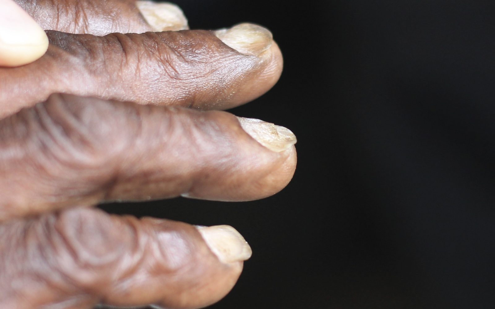 Photograph of spoon-shaped, brittle fingernails associated with chronic iron deficiency; clinical signs are supportive rather than diagnostic.