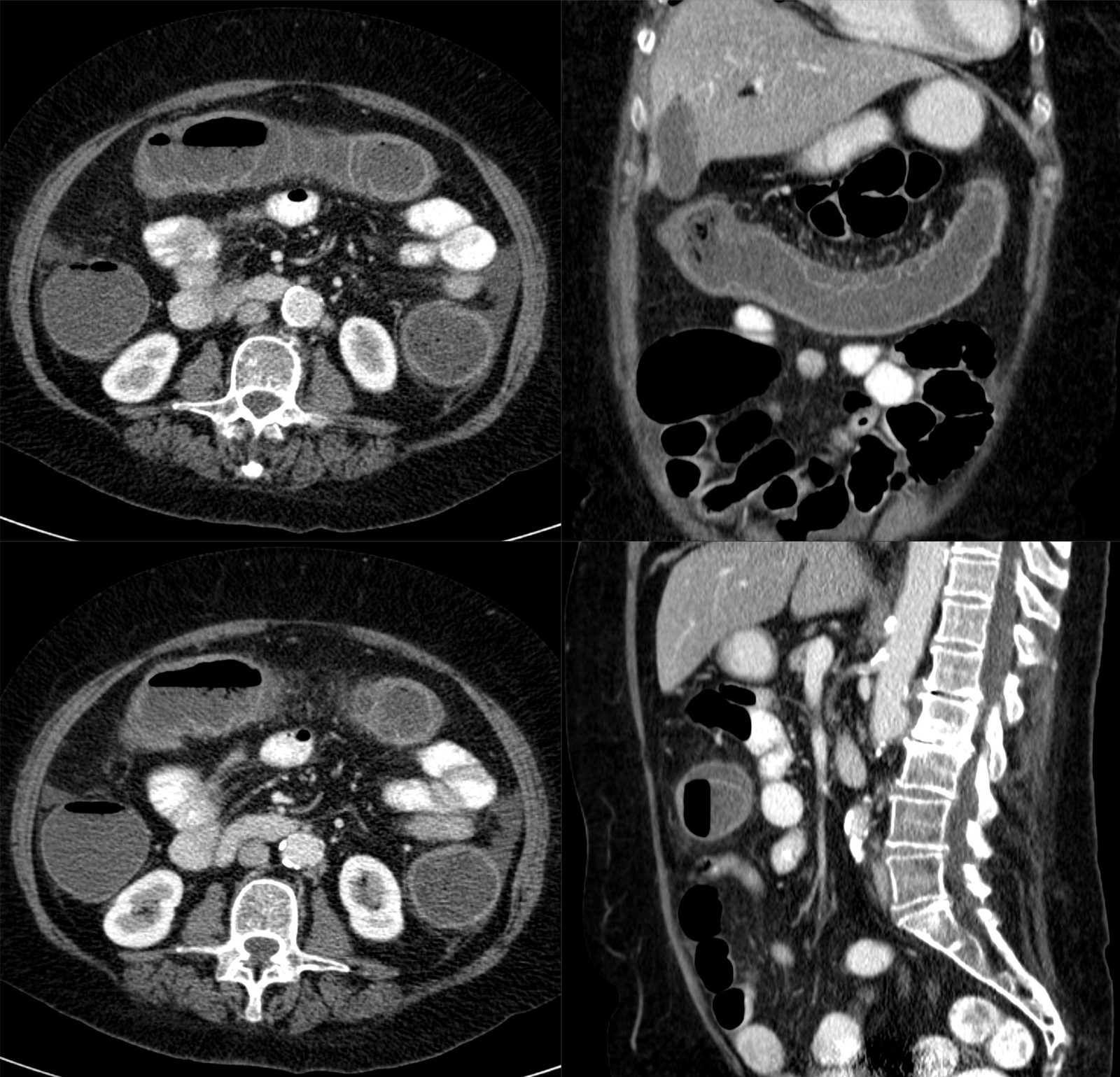 Axial contrast CT image showing segmental thickening of the splenic flexure with surrounding fat stranding, sparing adjacent bowel.