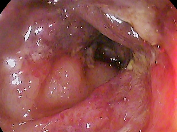 Colonoscopic image showing pale, oedematous mucosa with petechial haemorrhage and patchy ulceration in a segmental distribution.