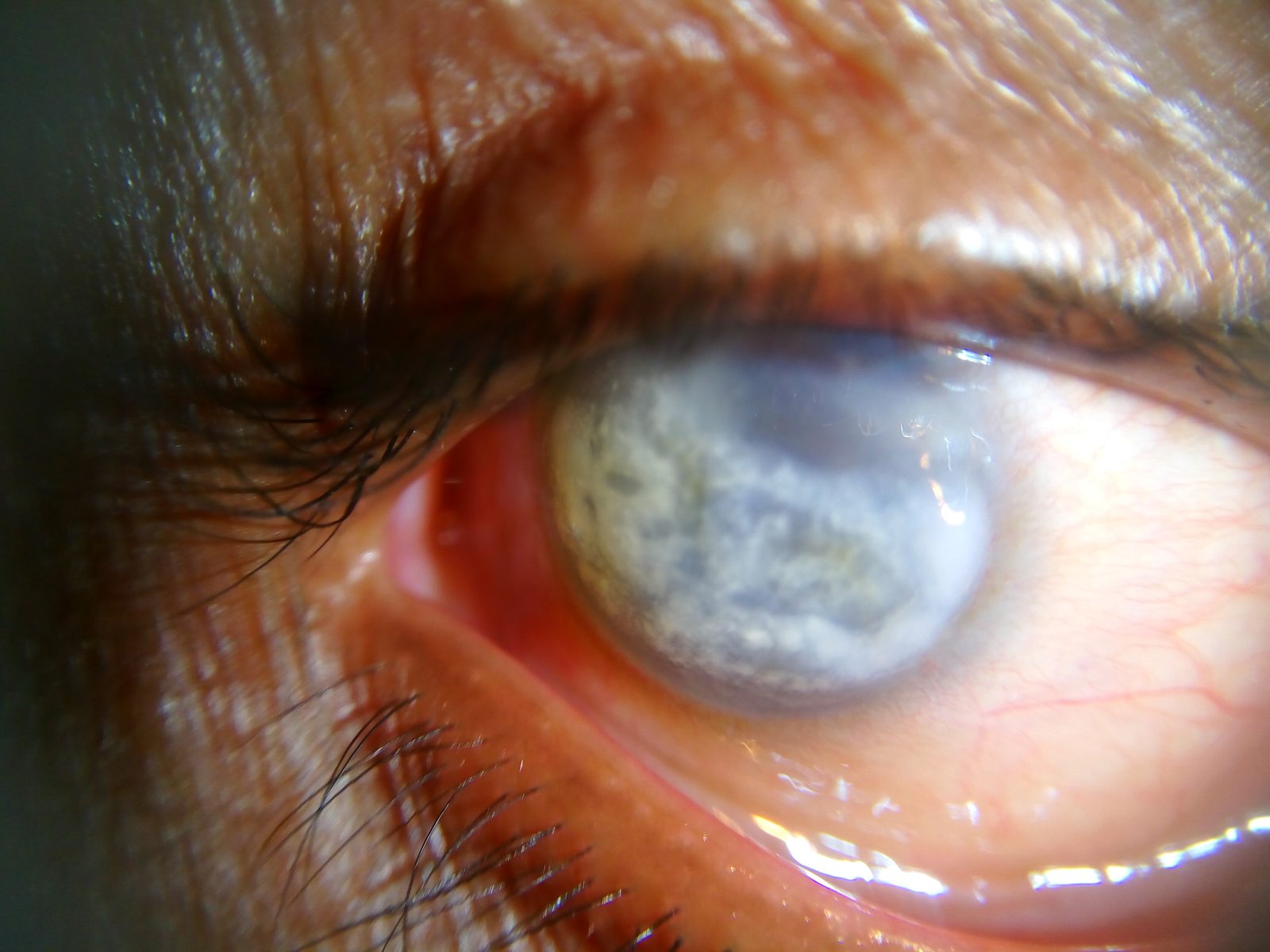 Clinical photograph showing dense band-shaped corneal calcium deposition, a sight-threatening complication of longstanding JIA-associated anterior uveitis.