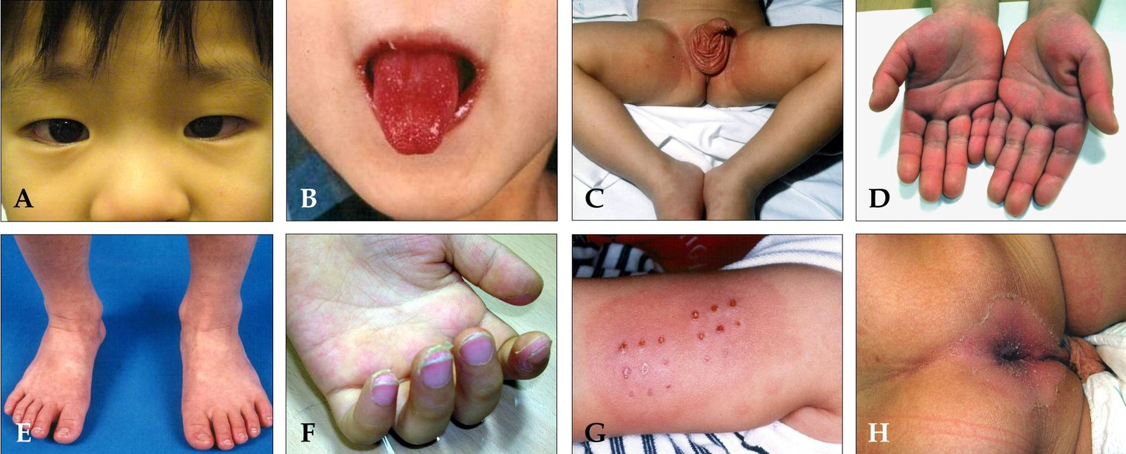 Clinical photograph or illustration of peeling around the fingers or toes in the subacute phase of Kawasaki disease; make clear that desquamation is a later feature and should not be awaited before referral.